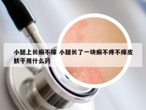 小腿上长癣不痒 小腿长了一块癣不疼不痒皮肤干用什么药