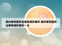 国内哪家医院治银屑病效果好 国内哪家医院治银屑病效果好一点