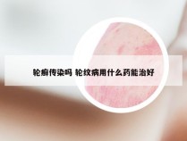 轮癣传染吗 轮纹病用什么药能治好