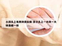 小孩头上有两块类似癣 孩子头上一大块一大块像癣一样