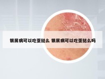 银屑病可以吃蛋挞么 银屑病可以吃蛋挞么吗