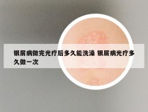 银屑病做完光疗后多久能洗澡 银屑病光疗多久做一次