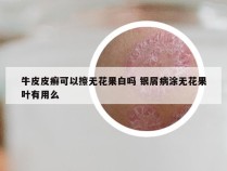 牛皮皮癣可以擦无花果白吗 银屑病涂无花果叶有用么