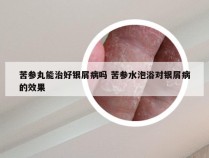 苦参丸能治好银屑病吗 苦参水泡浴对银屑病的效果