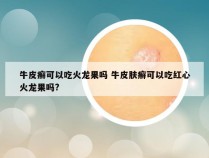 牛皮癣可以吃火龙果吗 牛皮肤癣可以吃红心火龙果吗?