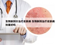 生物制剂针治疗皮肤病 生物制剂治疗皮肤病效果好吗