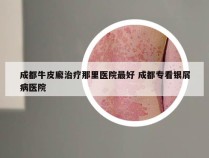 成都牛皮廨治疗那里医院最好 成都专看银屑病医院