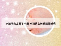 小孩子头上长了个癣 小孩头上长癣能治好吗