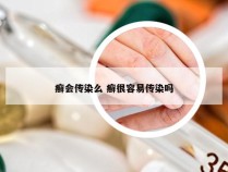 癣会传染么 癣很容易传染吗