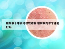 银屑病十年内可以攻破嘛 银屑病几年了还能好吗