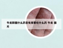 牛皮醉图什么药膏有用要吃什么药 牛皮 图片