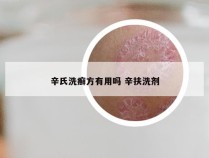 辛氏洗癣方有用吗 辛扶洗剂