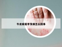 牛皮癣夏季发病怎么回事