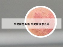 牛皮屑怎么治 牛皮屑该怎么治