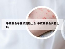 牛皮癣会单独长到脸上么 牛皮皮癣会长脸上吗