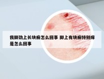 我脚劲上长块癣怎么回事 脚上有块癣特别痒是怎么回事