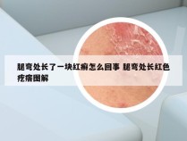 腿弯处长了一块红癣怎么回事 腿弯处长红色疙瘩图解