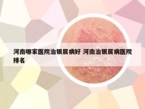 河南哪家医院治银屑病好 河南治银屑病医院排名