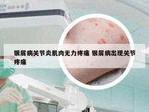 银屑病关节炎肌肉无力疼痛 银屑病出现关节疼痛