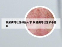 银屑病可以涂抹仙人掌 银屑病可以涂护手霜吗