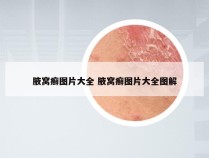 腋窝癣图片大全 腋窝癣图片大全图解