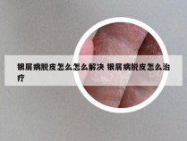 银屑病脱皮怎么怎么解决 银屑病脱皮怎么治疗