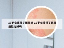 10岁女孩得了银屑病 10岁女孩得了银屑病能治好吗