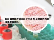 银屑病是血液里面缺少什么 银屑病是因为血液里有毒素吗