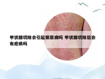 甲状腺切除会引起银屑病吗 甲状腺切除后会有疤痕吗