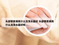 头部银屑病用什么洗发水最好 头部银屑病用什么洗发水最好呢