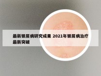 最新银屑病研究成果 2021年银屑病治疗最新突破