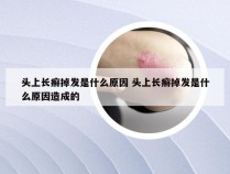 头上长癣掉发是什么原因 头上长癣掉发是什么原因造成的