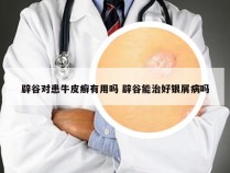 辟谷对患牛皮癣有用吗 辟谷能治好银屑病吗