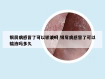 银屑病感冒了可以输液吗 银屑病感冒了可以输液吗多久