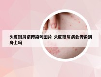 头皮银屑病传染吗图片 头皮银屑病会传染到身上吗