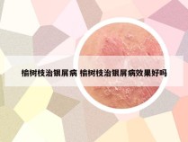 榆树枝治银屑病 榆树枝治银屑病效果好吗