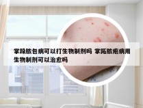 掌跺脓包病可以打生物制剂吗 掌跖脓疱病用生物制剂可以治愈吗