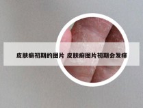 皮肤癣初期的图片 皮肤癣图片初期会发痒