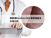 银屑病hacatecv304 银屑病是怎么染上的