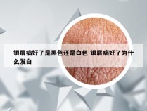 银屑病好了是黑色还是白色 银屑病好了为什么发白