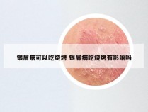 银屑病可以吃烧烤 银屑病吃烧烤有影响吗