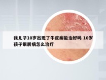 我儿子10岁出现了牛皮癣能治好吗 10岁孩子银屑病怎么治疗