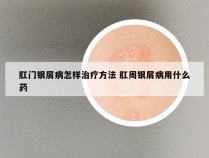 肛门银屑病怎样治疗方法 肛周银屑病用什么药