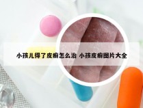 小孩儿得了皮癣怎么治 小孩皮癣图片大全