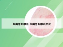 长癣怎么根治 长癣怎么根治图片