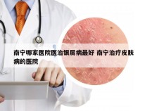 南宁哪家医院医治银屑病最好 南宁治疗皮肤病的医院