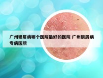 广州银屑病哪个医院最好的医院 广州银屑病专病医院