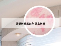 颈部长癣怎么办 颈上长癣