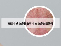 顽固牛皮血癣传染不 牛皮血癣会遗传吗