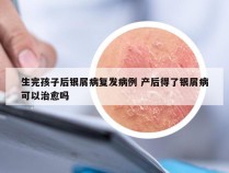 生完孩子后银屑病复发病例 产后得了银屑病可以治愈吗